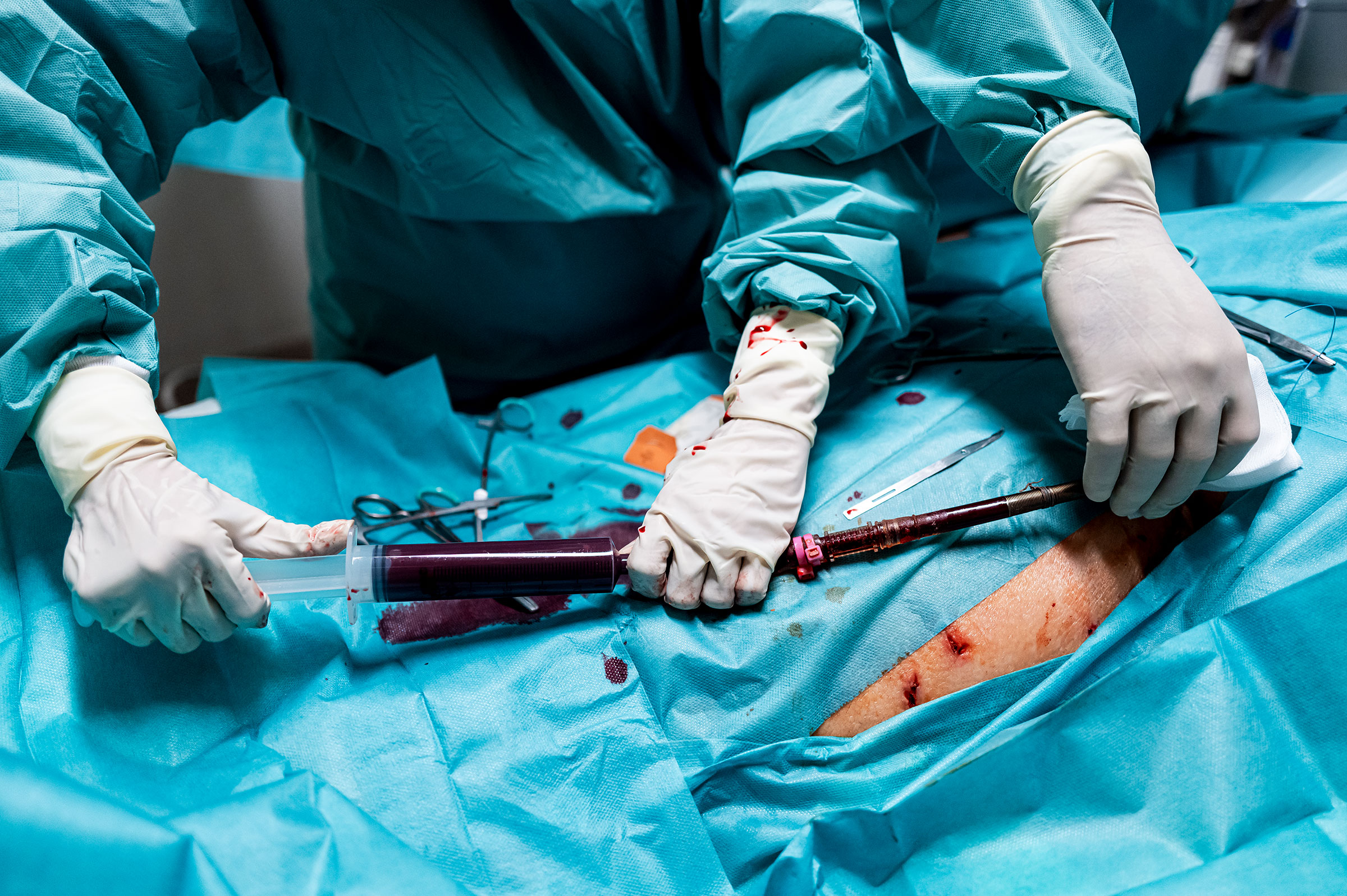 Neuaufnahme eines Patienten, der aus einer Operation kommt. Der zuständige Arzt (2.v.l.) erklärt den Pflegern, welche Maßnahmen notwendig sind und wie der Patient medikamentös eingestellt ist.