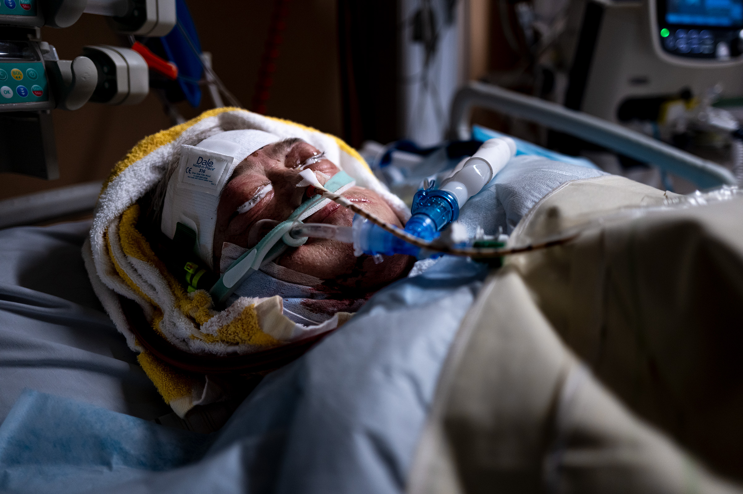 Ein sedierter Patient hat Salbe auf die Augen gestrichen bekommen damit diese nicht austrocknen. 